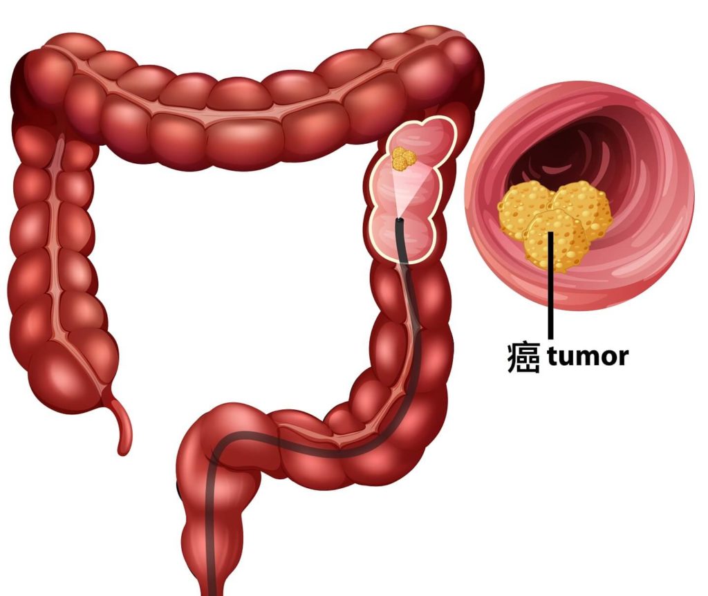 大腸癌