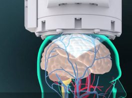 惡性腦瘤臨床試驗成功 手術導航導引聚焦超音波系統!