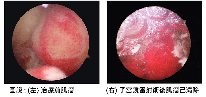 肌瘤手術前後對比照