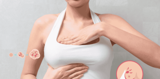16yr Breast Cancer