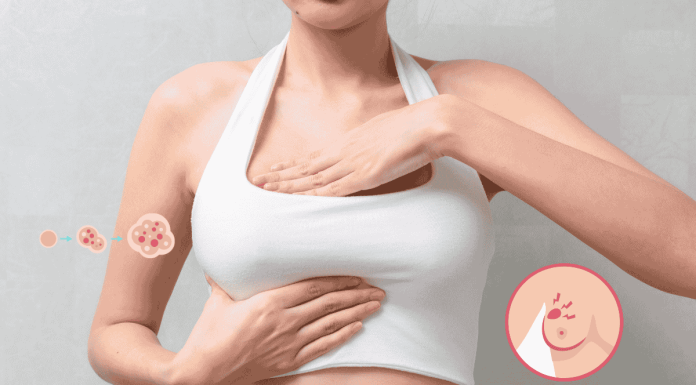 少女16歲就得乳癌!NG生活習慣全踩雷,醫揭4大致癌因素 16yr Breast Cancer
