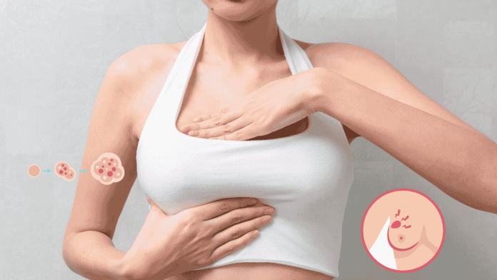 16yr Breast Cancer