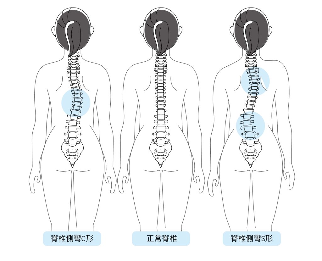 正常脊椎與脊椎側彎