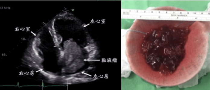 22歲女夜裡不能動彈 心臟黏液瘤 致全身多處栓塞險喪命！（圖左為患者陳小姐的心臟超音波照，標示處為黏液瘤位置；圖右為心臟動脈瘤)
