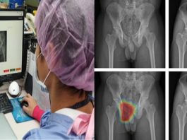 AI輔助外傷影像診斷 助事故傷害者：(圖左)長庚急診醫師利用AI輔助外傷影像診斷；(圖中上)右側恥骨骨折(圖中下) AI輔助熱點(右上)左側股骨骨折(右下)AI輔助熱點