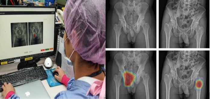 AI輔助外傷影像診斷 助事故傷害者：(圖左)長庚急診醫師利用AI輔助外傷影像診斷；(圖中上)右側恥骨骨折(圖中下) AI輔助熱點(右上)左側股骨骨折(右下)AI輔助熱點