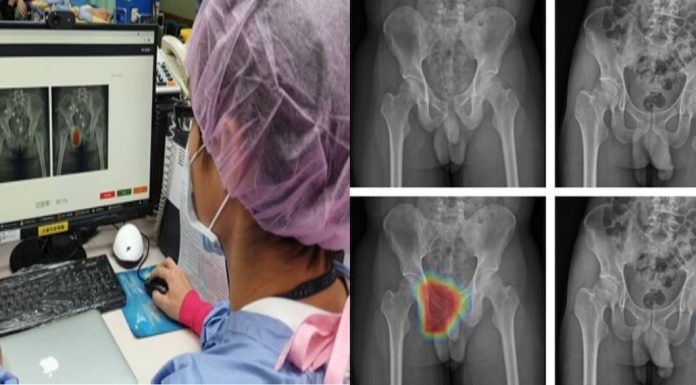 AI輔助外傷影像診斷 助事故傷害者：(圖左)長庚急診醫師利用AI輔助外傷影像診斷；(圖中上)右側恥骨骨折(圖中下) AI輔助熱點(右上)左側股骨骨折(右下)AI輔助熱點