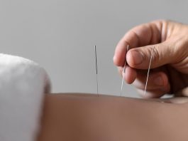 Acupuncture