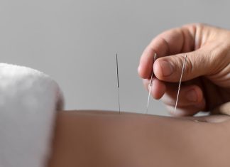 Acupuncture