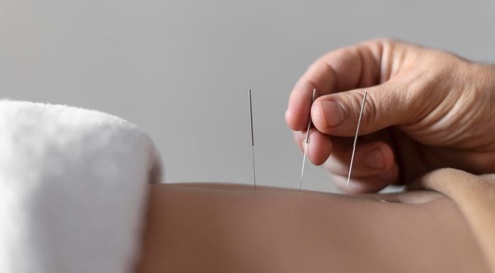 Acupuncture