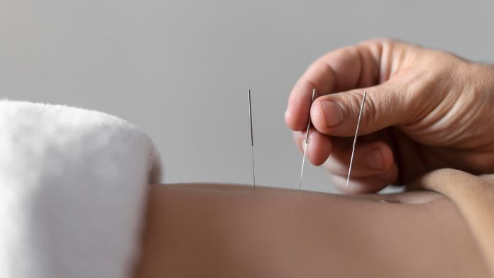 Acupuncture