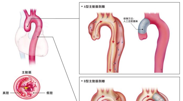 主動脈剝離是猝死常見原因，國內每年約有近2千人發病。(長庚醫院提供)