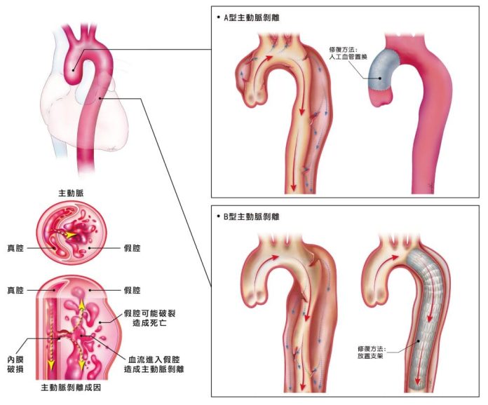 主動脈剝離是猝死常見原因，國內每年約有近2千人發病。(長庚醫院提供)