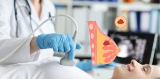 Breast Cancer Is Affecting Younger Individuals