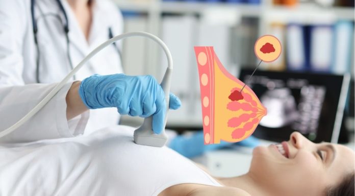 Breast Cancer Is Affecting Younger Individuals