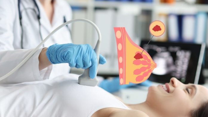 Breast Cancer Is Affecting Younger Individuals
