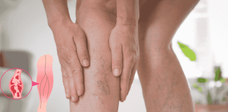 Deep Vein Thrombosis