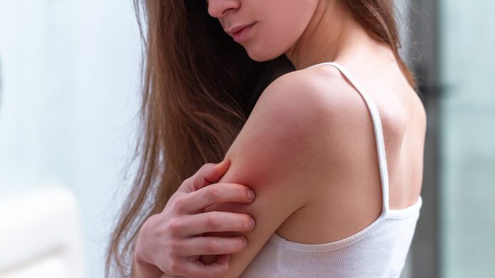 Dermatitis