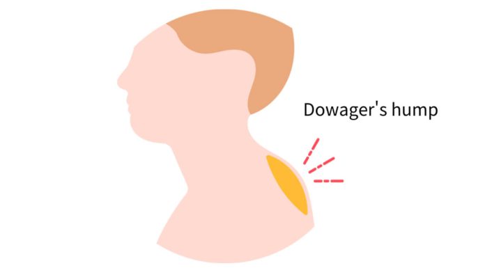 Dowager's Hump