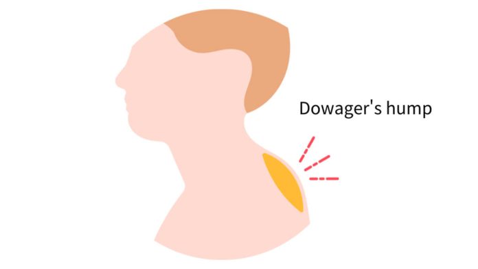 Dowager's Hump
