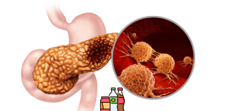 Drinking sugary beverages increases the risk of pancreatic cancer