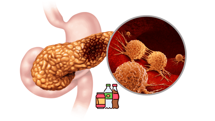 Drinking sugary beverages increases the risk of pancreatic cancer