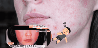 Erythema Infectiosum