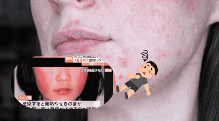 Erythema Infectiosum