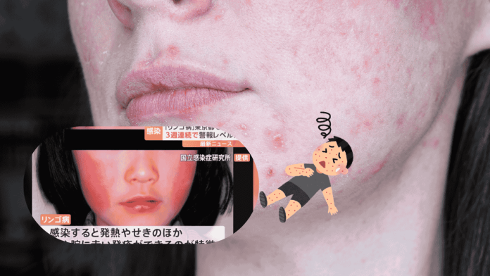 Erythema Infectiosum