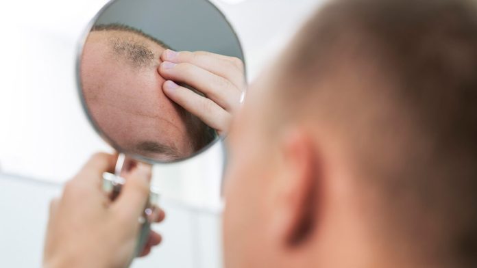 Follicular Unit Transplantation
