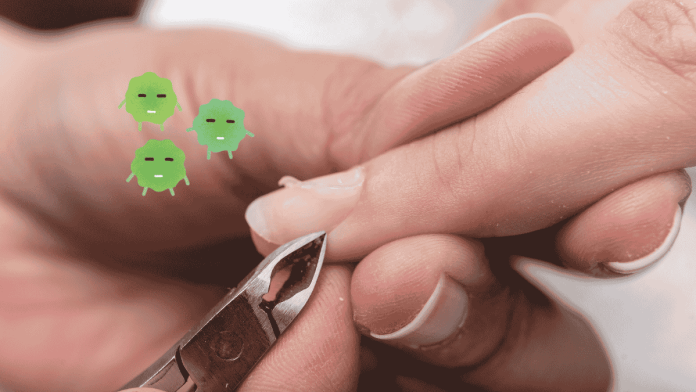 Hangnail