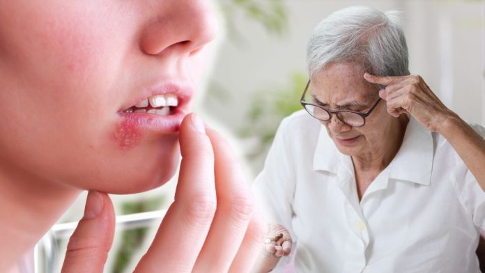 Human Herpes Virus Accelerates The Development Of Alzheimer's Disease