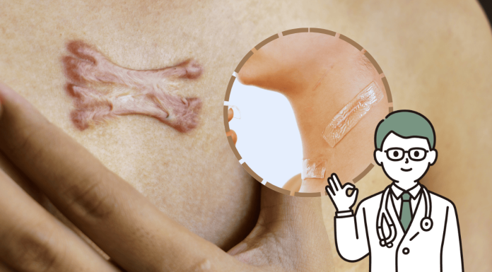 Keloid Scar Silicone Sheets