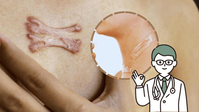Keloid Scar Silicone Sheets