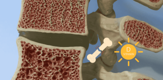 Osteoporosis