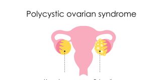 PCOS