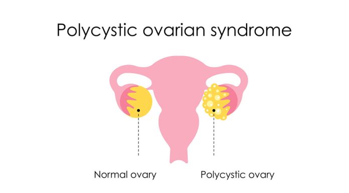 PCOS
