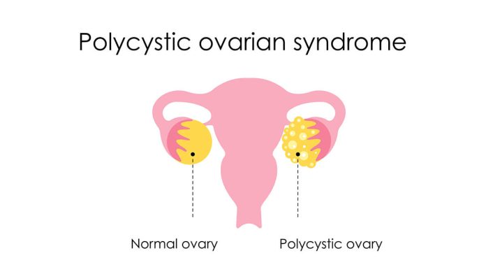 PCOS