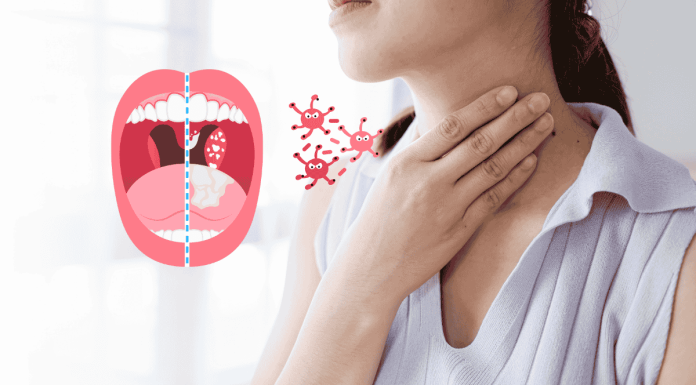 Peritonsillar Abscess