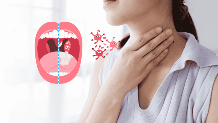 Peritonsillar Abscess