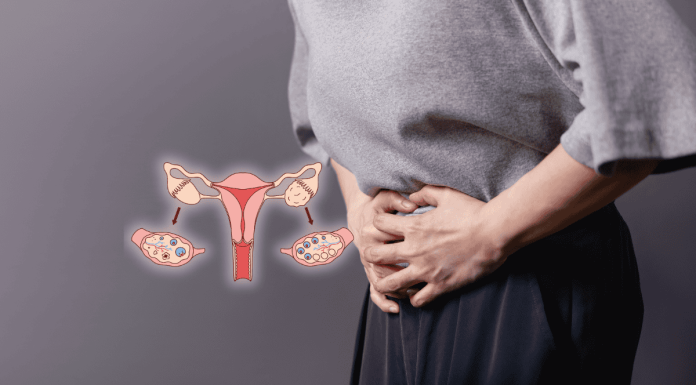 Polycystic Ovaries Syndrome Integration Of Traditional And Western Medicine