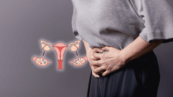 Polycystic Ovaries Syndrome Integration Of Traditional And Western Medicine