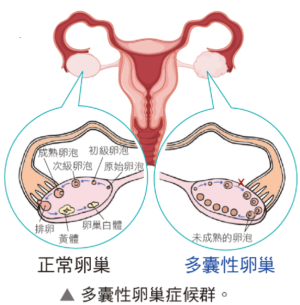 多囊性卵巢症候群