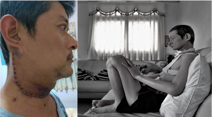 口腔癌第二期患者夏先生照片，圖左：夏先生進行頭頸癌手術後疤痕；圖右：醫師宣判僅剩1個月生命，夏先生住進安寧病房。