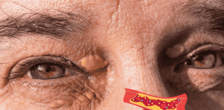 Xanthelasma