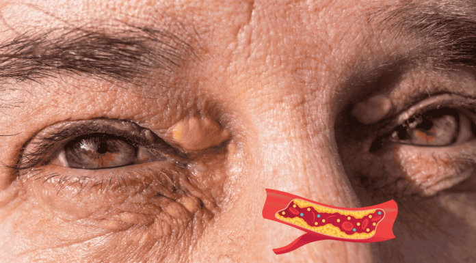 Xanthelasma