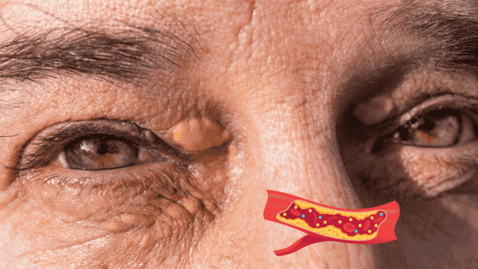 Xanthelasma