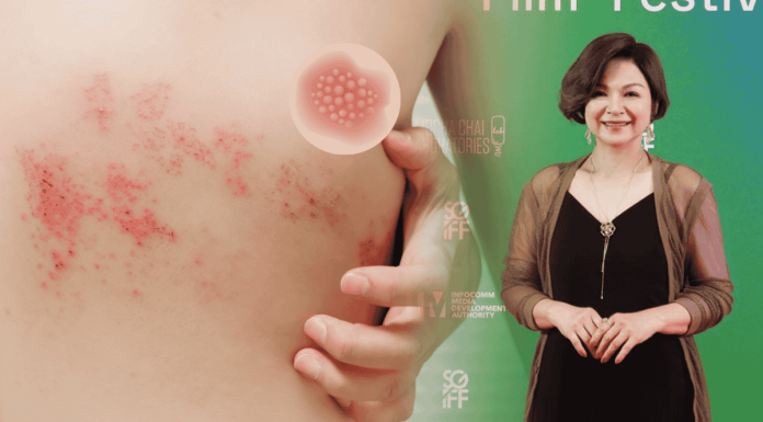 Yang Kuei Mei Shingles