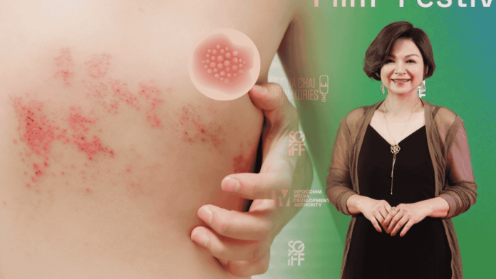Yang Kuei Mei Shingles