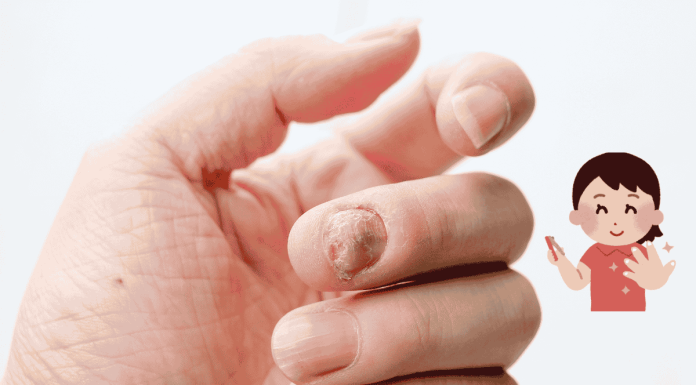Abnormal Nail
